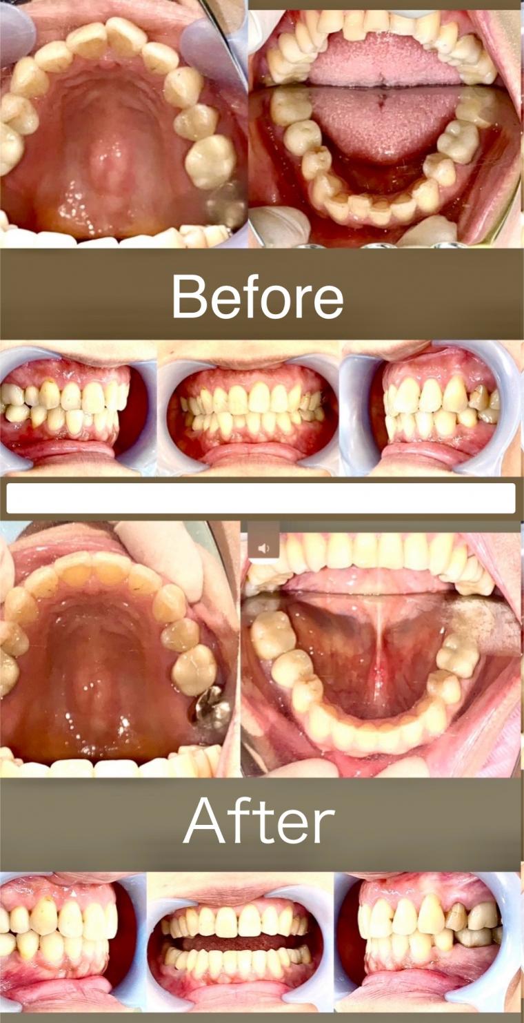 目立たない部分矯正できますよ！
