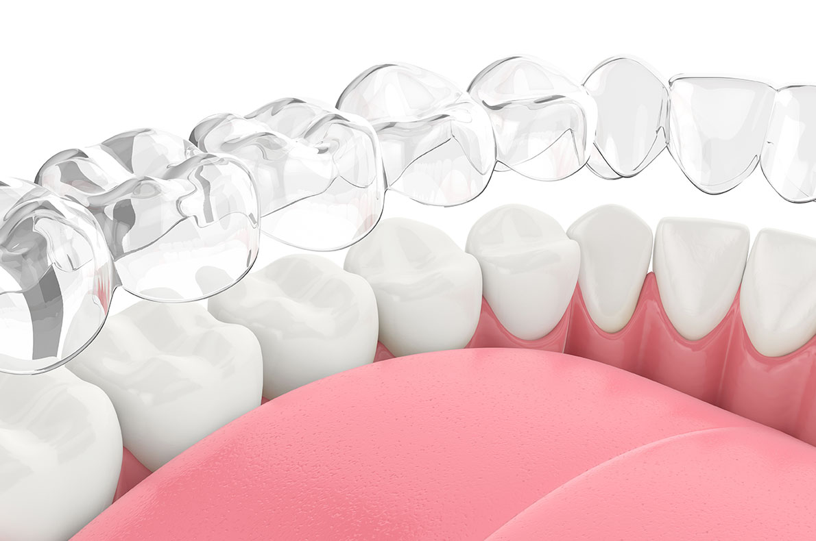 マウスピース型装置（インビザライン）による矯正歯科治療