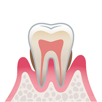 歯周炎（中度）