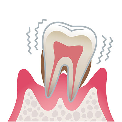 歯周炎（重度）
